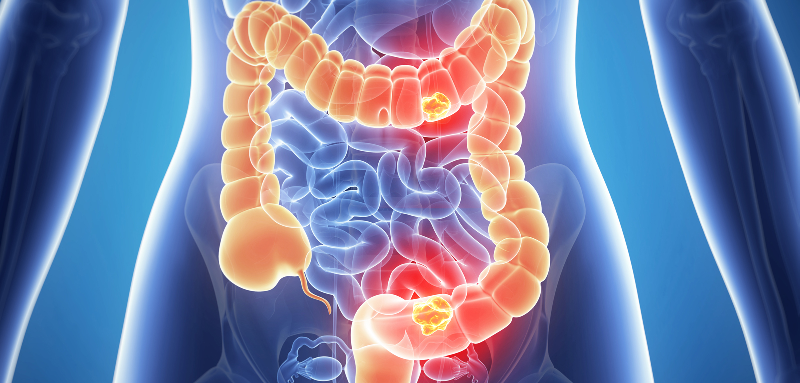 Bowel Cancer Image 1600x767px