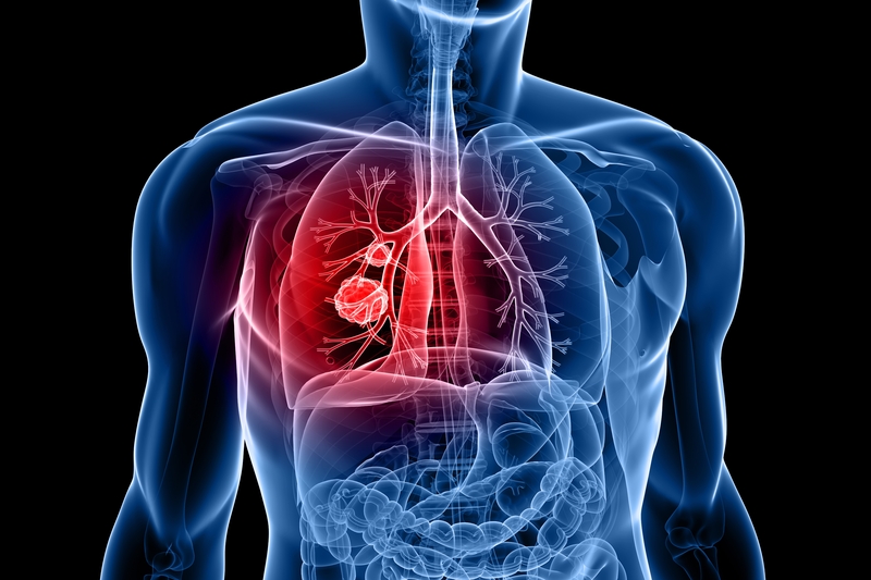 Lung cancer x-ray